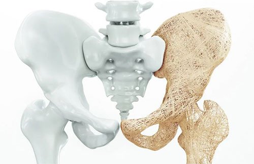 En los hombres mayores, se pueden producir fracturas de cadera (Ilustración: UNAM)